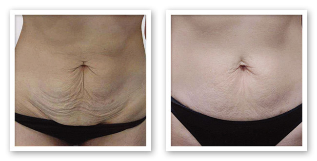 Belly Before and After ThemaCell treatment
