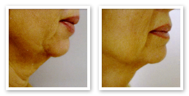 Chin Before and After ThemaCell treatment