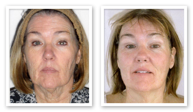 Face Before and After ThermaCall treatement