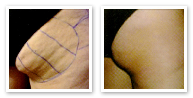 Hip Before and After ThemaCell treatment