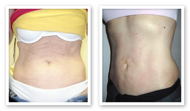 Midriff area Before and After ThemaCell treatment
